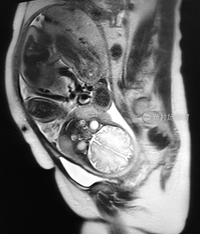 胎儿和孕妇MRI T2体重图像